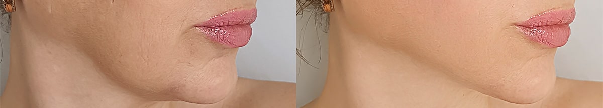 Kybella & CoolSculpting