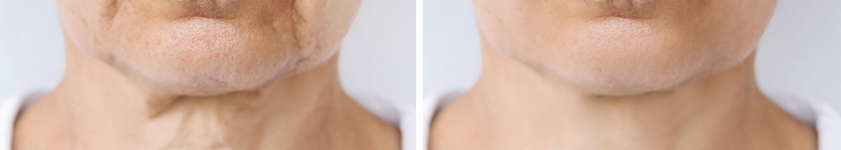 Laser & Ultrasound Treatments