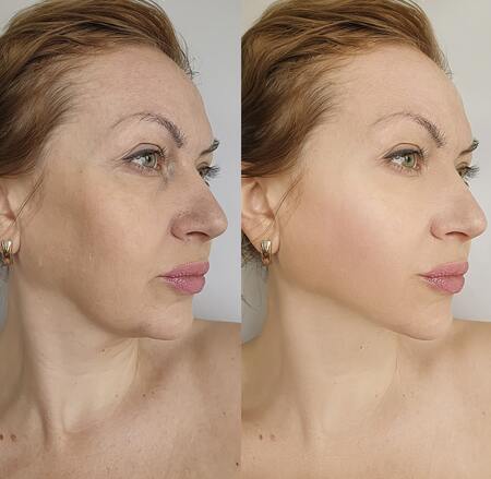 before after result