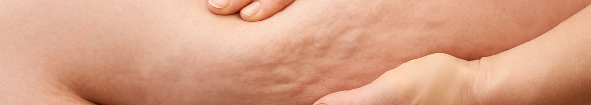 Cellulite and Skin Treatments