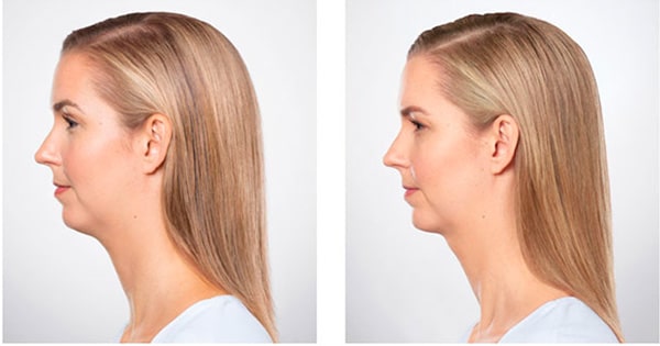 Kybella
