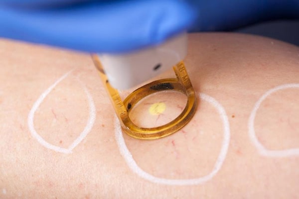 Close-up of smooth legs after laser spider vein removal treatment in NYC.
