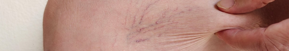 Vascular & Skin Lesion Treatments