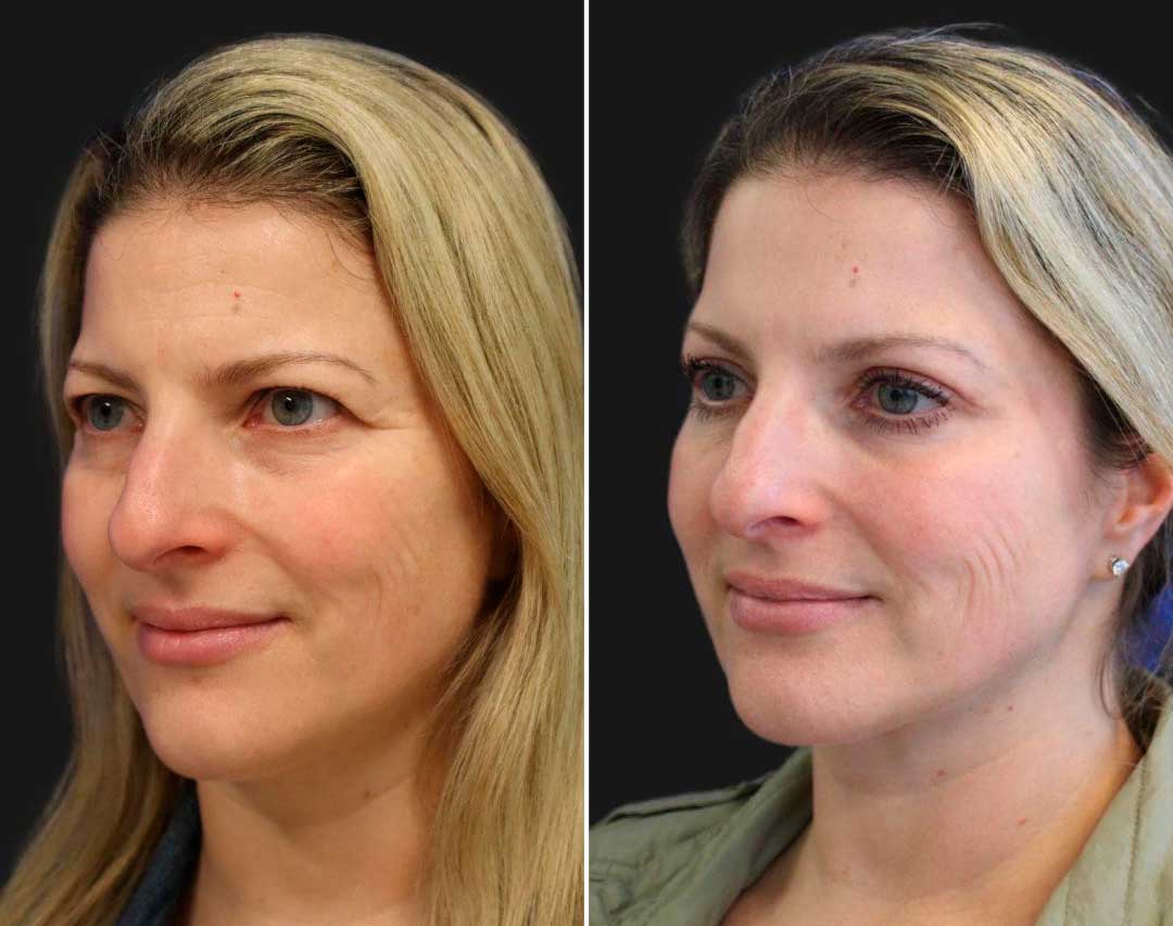 Eye area Botox results – softened wrinkles around eyes, Dr. Fuzayloff