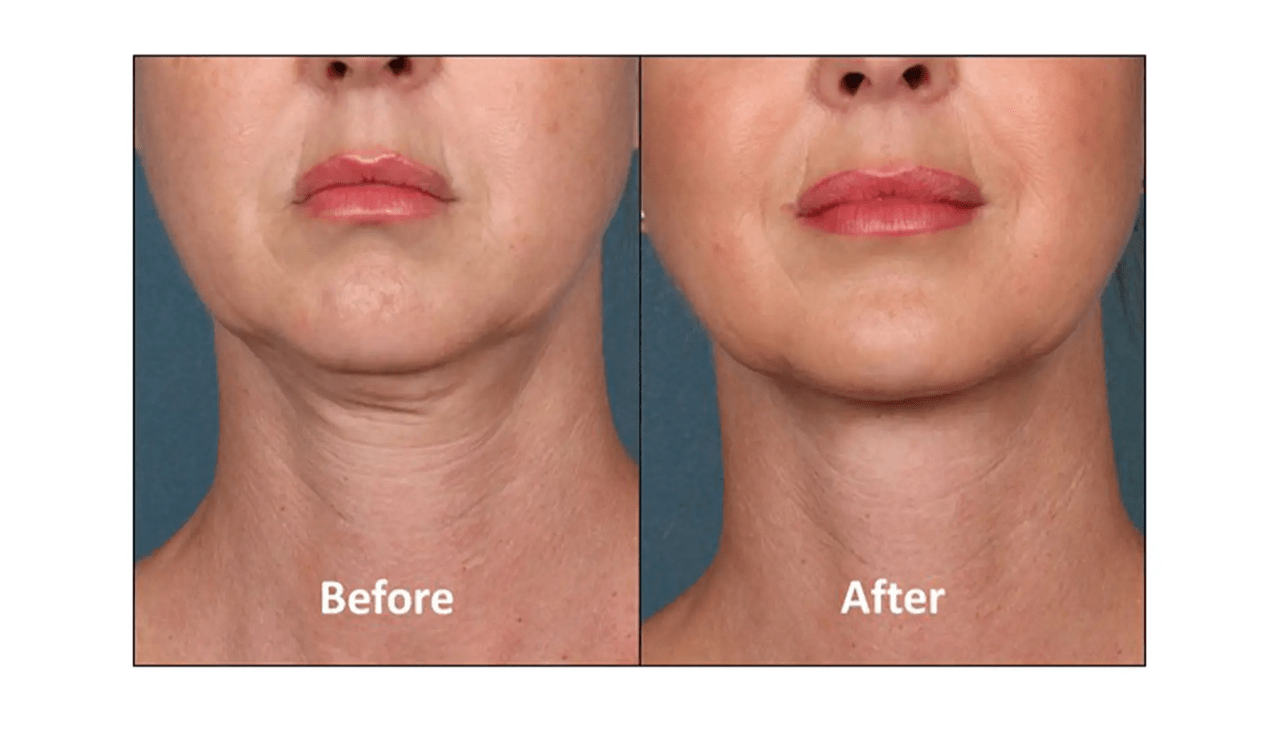Chin Botox treatment – refined contour by Dr. Fuzayloff, NYC