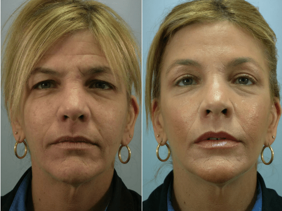 Before and after Botox eyebrow lift – Midtown Med Spa NYC