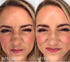 Bunny line reduction with Botox – natural aesthetic result, Manhattan