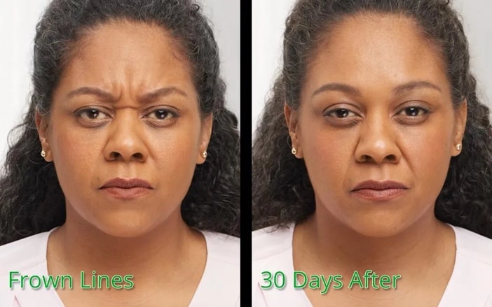 Before and after Botox between eyebrows (glabellar lines) – Midtown Med Spa NYC