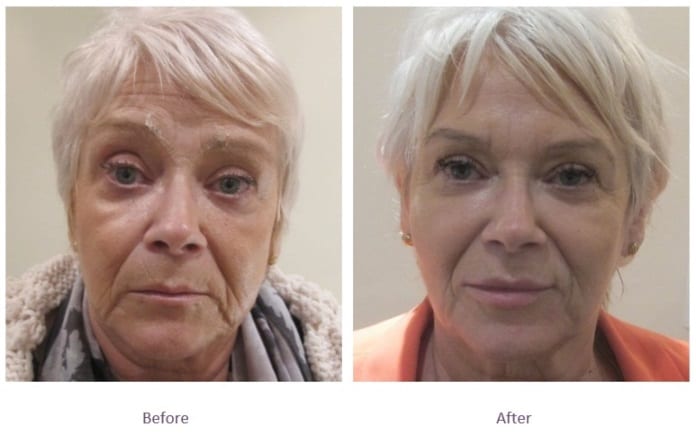 Dermal filler chin enhancement – natural facial harmony, Manhattan