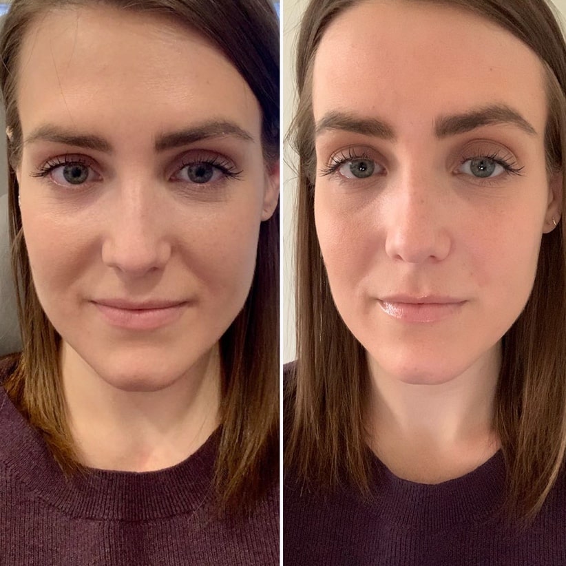 Smile line filler results – softened folds around mouth, Dr. Fuzayloff