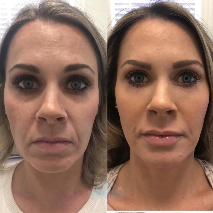 Lower face rejuvenation with filler – lifted corners of mouth, Dr. Fuzayloff