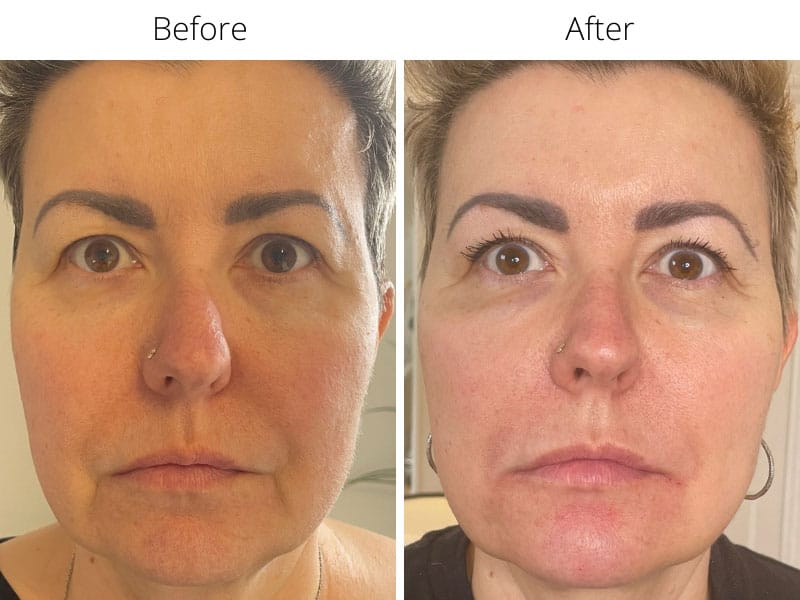 Marionette line filler treatment – natural aesthetic result, Manhattan