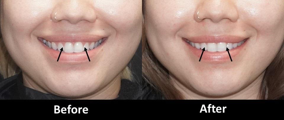 Botox smile enhancement – less gum show, natural balance, NYC