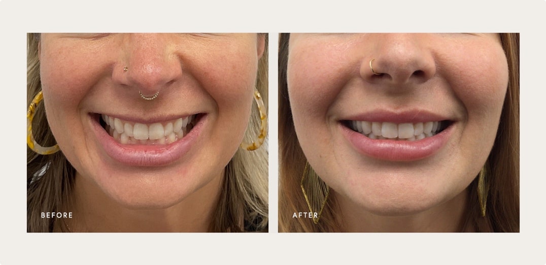 Upper lip definition improvement – Botox lip flip result, Manhattan